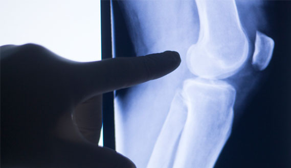 ¿Qué es y cómo combatir la artritis ósea?