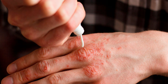 Condiciones que pueden mejorar los pacientes con artritis psoriásica