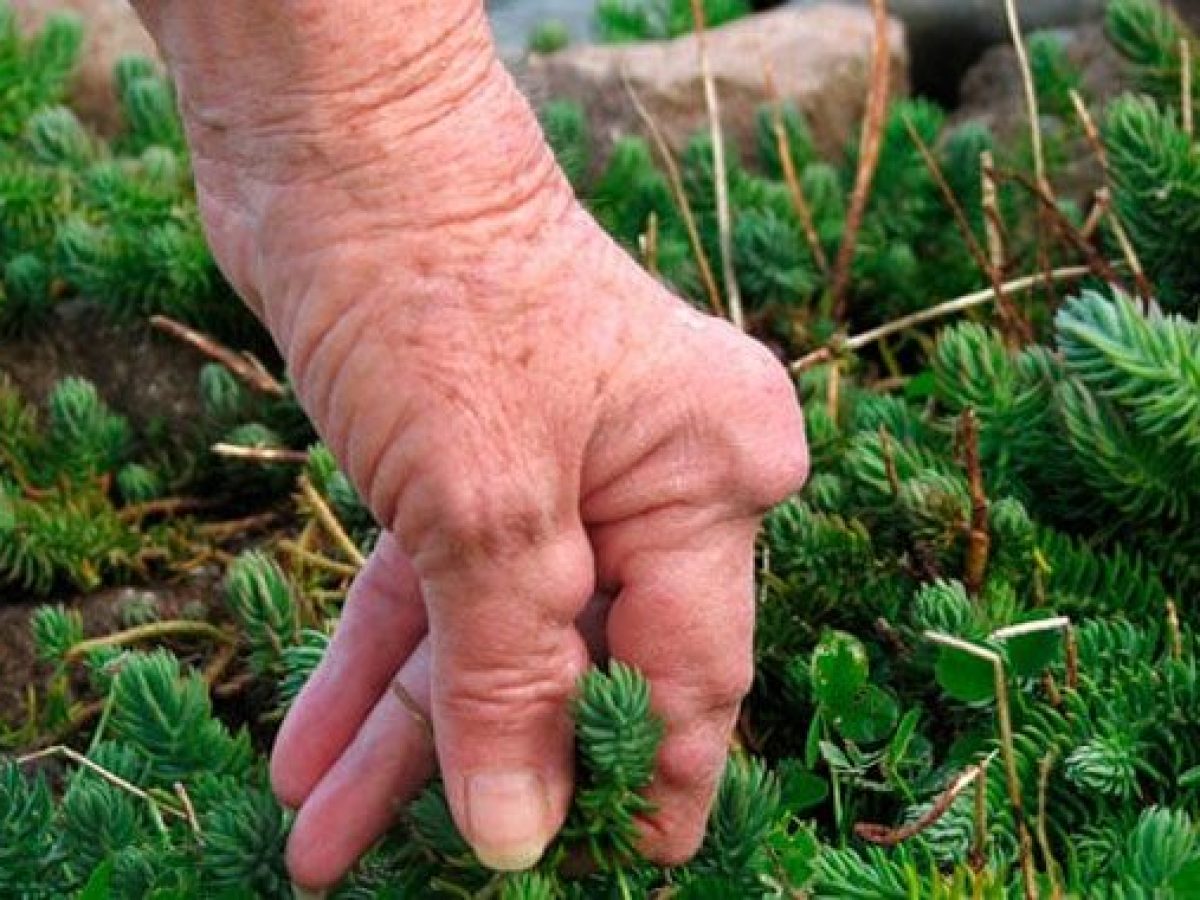 nódulos de artritis reumatoide en los dedos