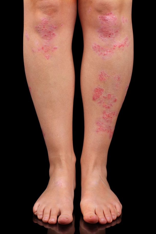 Psoriasis Síntomas y causas Revista Artritis y Reumatología