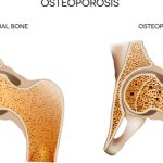 Osteoporosis dolor e incomodidad para quien lo padece