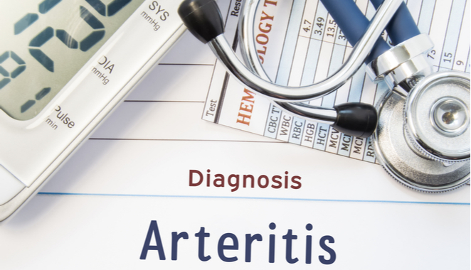 La arteritis de células gigantes  y la inflamación de las arterias