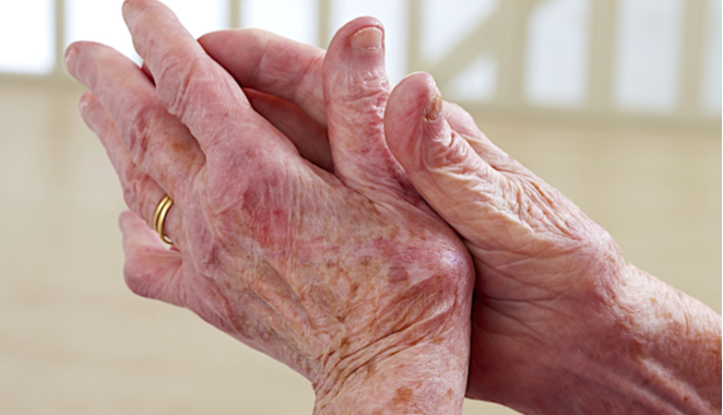 Artritis psoriásica o lupus