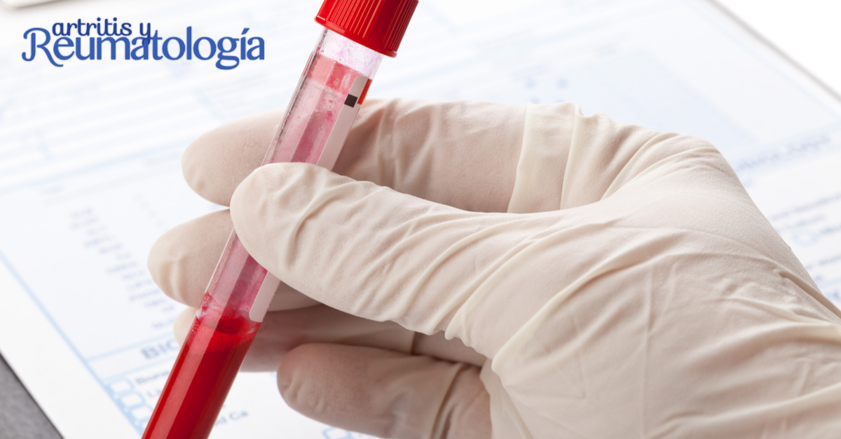 Velocidad de sedimentación prueba que ayuda a diagnosticar enfermedades inflamatorias o musculares
