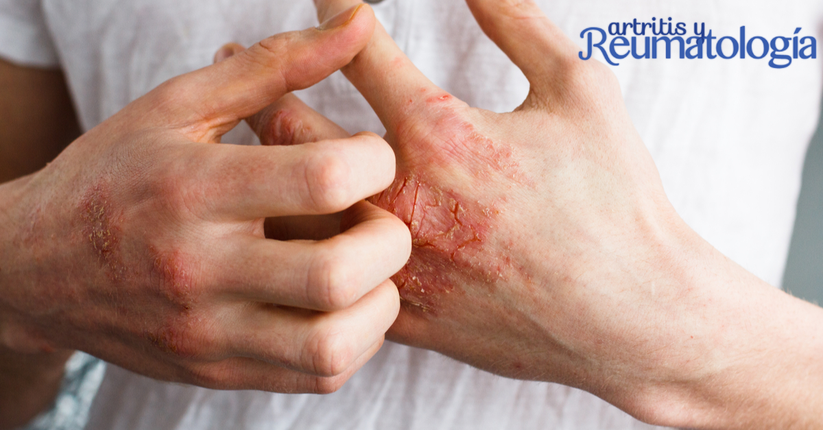 Diferentes tipo de psoriasis que pueden afectar - Revista Artritis y ...