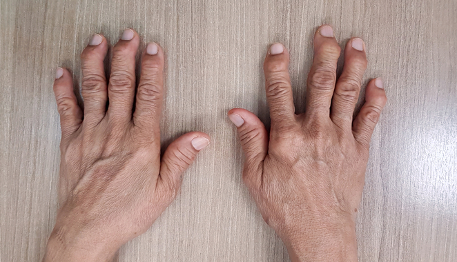 Reumatóloga explica la diferencia entre la artritis reumatoide y la artritis degenerativa