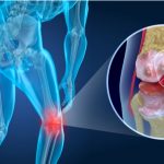¿Qué diferencia hay entre artritis y artrosis?