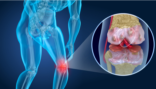 ¿Qué diferencia hay entre artritis y artrosis?