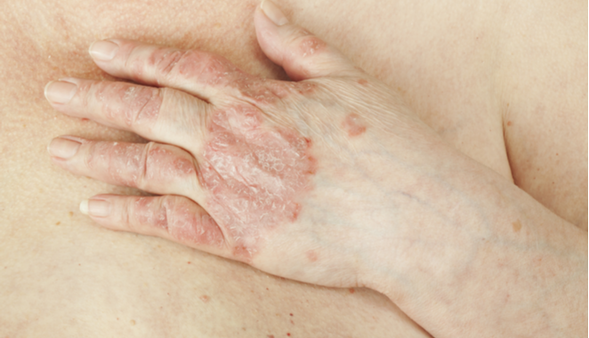 6 factores que aumentan el riesgo de desarrollar artritis psoriásica