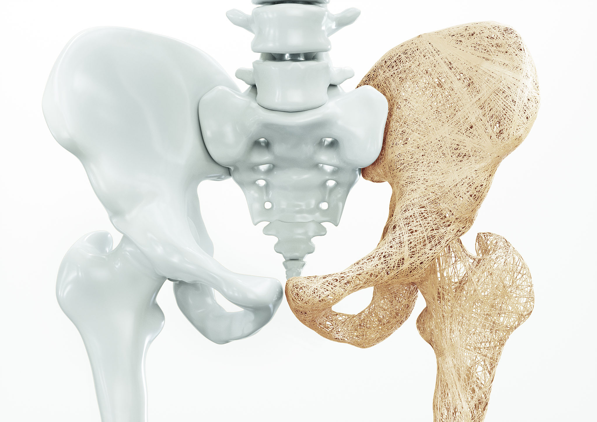 Osteoporosis: 7 casos de fractura de cadera por cada 1.000 habitantes